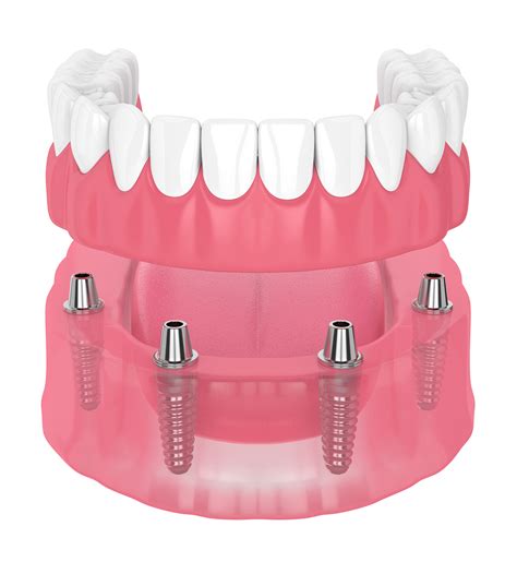 Tratamentos Implantodontia Protocolo Odhos Odontologia Personalizada Hot Sex Picture