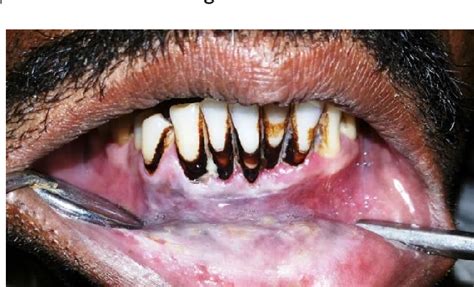 Figure 1 From A Case Series Smokeless Tobacco Induced Oral Premalignant