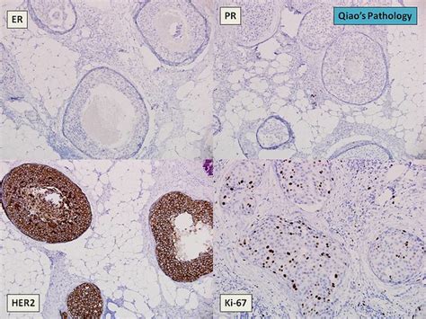 Qiaos Pathology Pleomorphic Lobular Carcinoma In Situ Plcis Of The Breast A Photo On