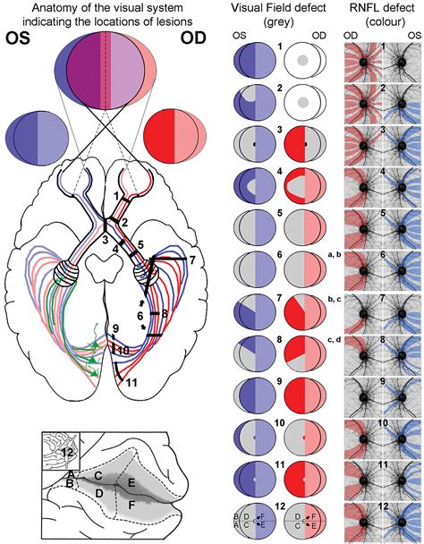 Reconciling Visual Field Defects And Retinal Nerve Fibre Layer Asymmetric Patterns In Retrograde