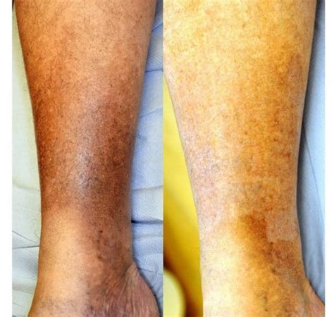 Haemosiderin Brown Stains Treatment The Whiteley Clinic