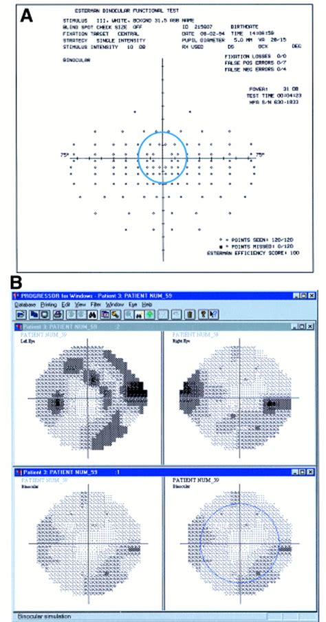 Simulating Binocular Visual Field Status In Glaucoma British Journal