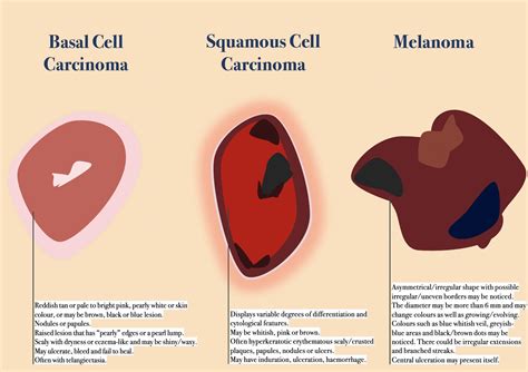 Update More Than Squamous Cell Carcinoma Histology Drawing Super