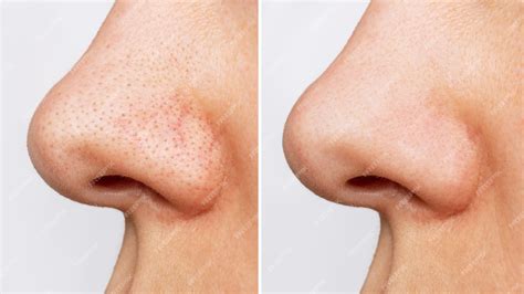 Premium Photo Closeup Of Woman Nose With Blackheads Or Black Dots Before And After Peeling And