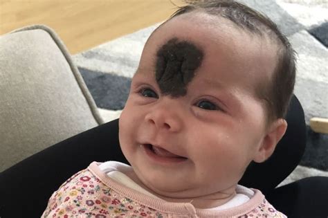 Dad Claims Nhs Refused To Operate On Newborns Huge Forehead Birthmark