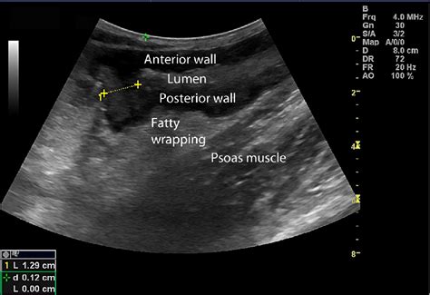 Figure 1 From Ultrasound In Crohns Disease Bowel Wall