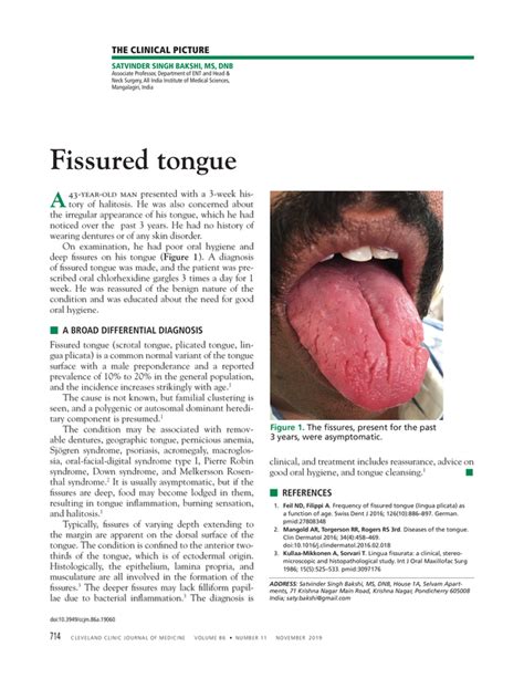 Fissured Tongue Cleveland Clinic Journal Of Medicine