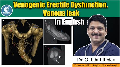 Venogenic Erectile Dysfunction Venous Leak Dr Rahul Reddy Androcare Andrology Institute