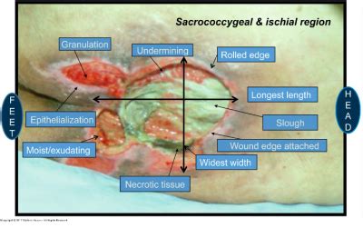 Maceration is the process by which organized tissue is transformed into a suspension of intact cells, resulting in pulpy hence, in terms of the definition of euthanasia, this methodology meets the criteria. Exam 1: Chap. 58 Special Skin and Wound Care at Missouri ...