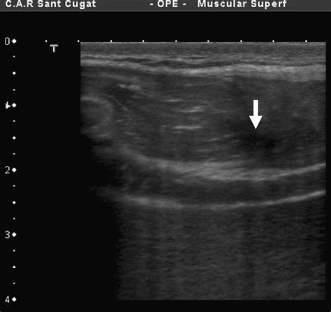 Longitudinal Ultrasound Image Of The Same Injury Download Scientific