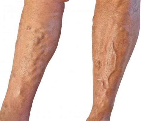 Varicose Veins Causes Symptoms Treatment Diagnosis