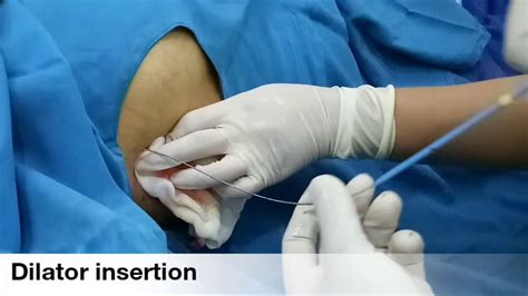 Pigtail Pleural Catheter Youtube