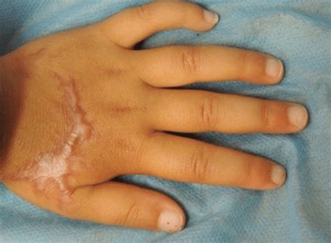 A Laceration On The Dorsum Of Lt Hand Closed By Oca B Hypertrophic