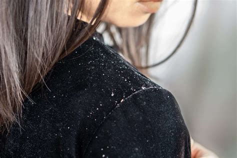 Details More Than 75 Flakes In Hair Ineteachers