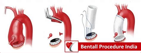 Bentall Surgery Advance Cardiac Hospitals In India