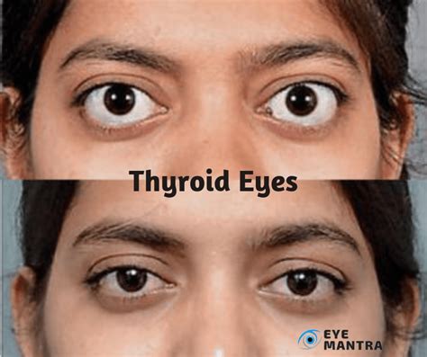 Thyroid Eye Disease Risks Symptoms Causes Treatment EyeMantra