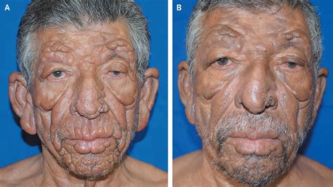 Lepromatous Leprosy Definition Causes Symptoms Diagnosis Treatment