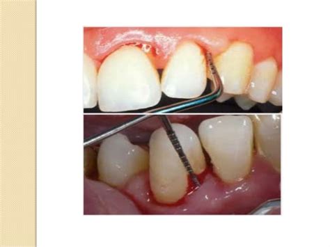 Bleeding On Probing Periodontics