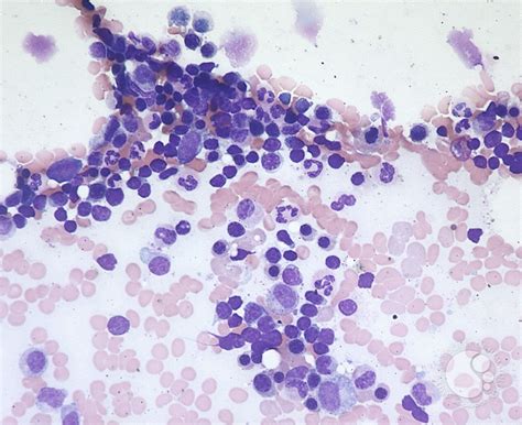 Lymphocytosis Bone Marrow 1