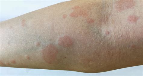 How To Identify Rashes And Other Lupus Skin Symptoms