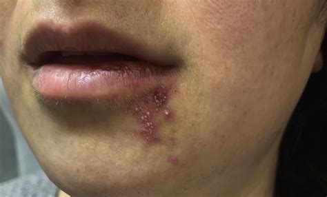 Woman With A Painful Rash On Face Annals Of Emergency Medicine