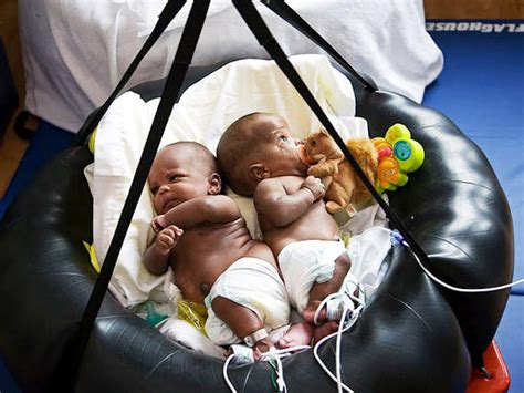 Medical Miracle Conjoined Twins Separated In Memphis Photo 4 Pictures Cbs News