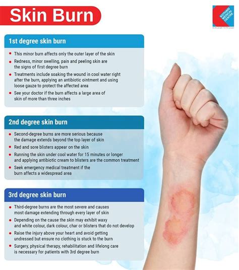 How To Take Care Of 3rd Degree Burns