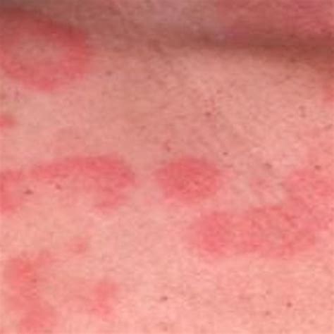 Serious Conditions That Rashes And Hives Can Indicate Things Health