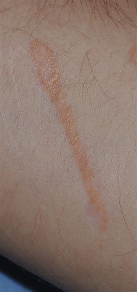 Scar Treatment For Self Induced Scars On The Arms Seattle Bellevue