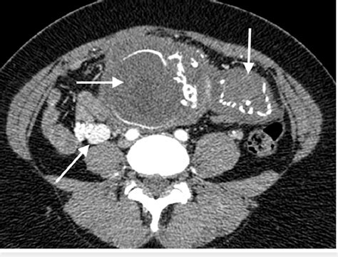 Axial Post Contrast Ct Arterial Phase Demonstrating Fetal Head With