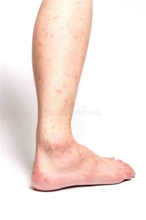 Eczema On Skin Stock Photo Image Of Sclerosis Closeup 8959704