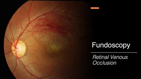 Retinal Venous Occlusion Fundoscopy Youtube