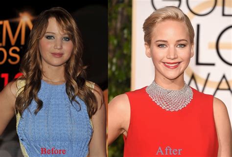 Jennifer Lawrence Plastic Surgery Before And After Face