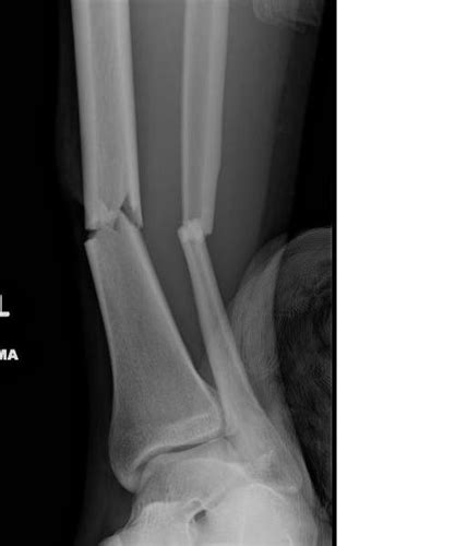 Tibial Shaft Fractures Trauma Orthobullets