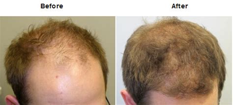 Maybe you would like to learn more about one of these? Finasteride for Hair Loss | MedGuidance