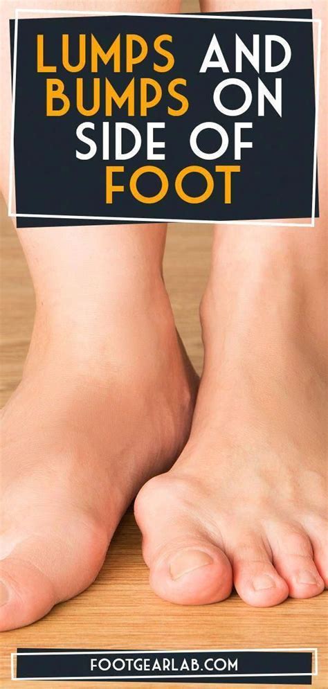 Lumps And Bumps On Side Of Foot Top Causes And Remedies Lumps Bumps Foot Footpain