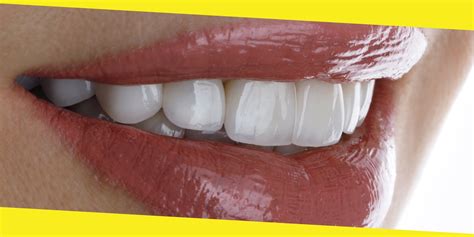 What To Know Before Getting Porcelain Veneers Most Inside