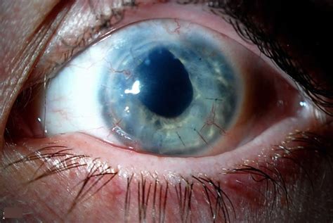 Neovascularization And Eye Neovascularization