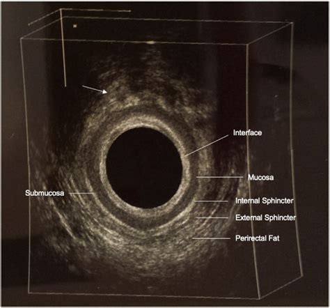 Endoanal Ultrasound Eaus Image Showing A Perianal Mass At 11 Oclock Download Scientific
