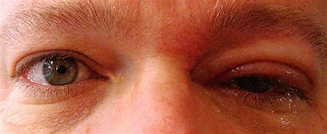 Shingles In The Eye Symptoms Causes And Treatments