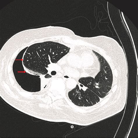 Computed Tomography Scan Showing Abnormal Visceral Pleural Thickening