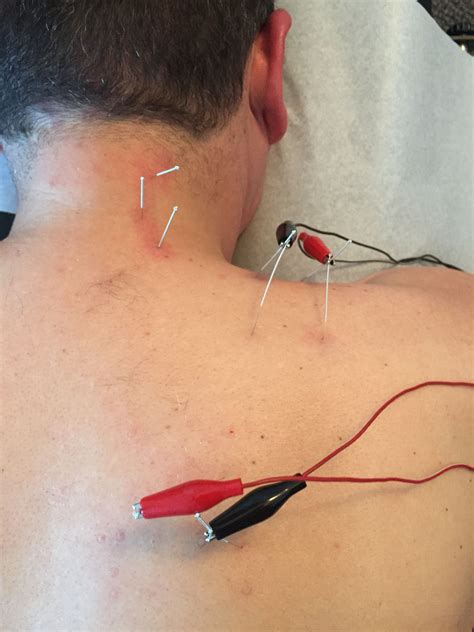 Acupuncture Helps Relieve Shoulder And Neck Pain Neck Pain