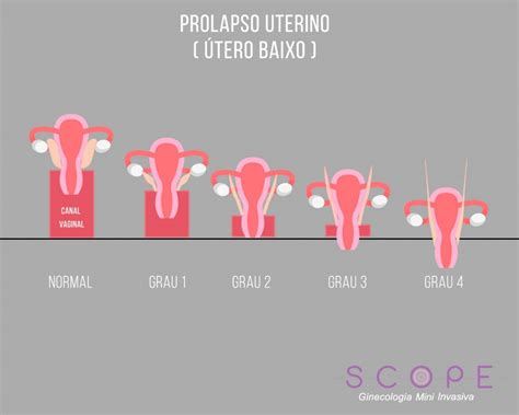 Prolapso uterino conheça causas e tratamentos Scope Ginecologia