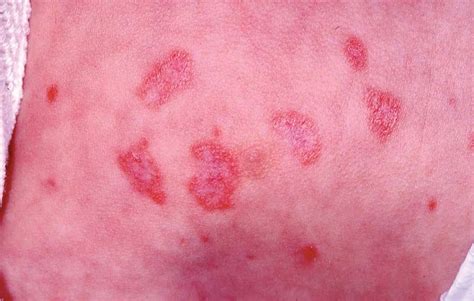 Lupus Eritematoso Neonatal 4 Casos Y Revisión Clínica Actas Dermo