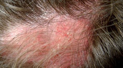 Alopecia E Lupus Eritematoso Sistemico Le Correlazioni Da Non