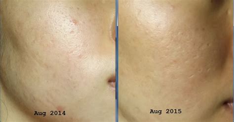 Treatment Depressed Acne Scars After Dermarolling At Home Cindity