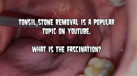 Tonsiloliths And Stone Popping Why Do We Love It Youtube
