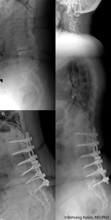 Roentgen Ray Reader Sagittal Balance And The Flat Back Syndrome