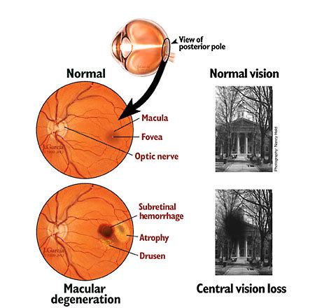 We did not find results for: Macular Degeneration - Abedi Laser and Cosmetic Eye Center