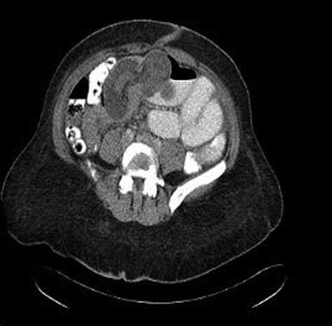 Ct Scan Noting Bowel Within Bowel Suggesting Intussusception Ct Scan